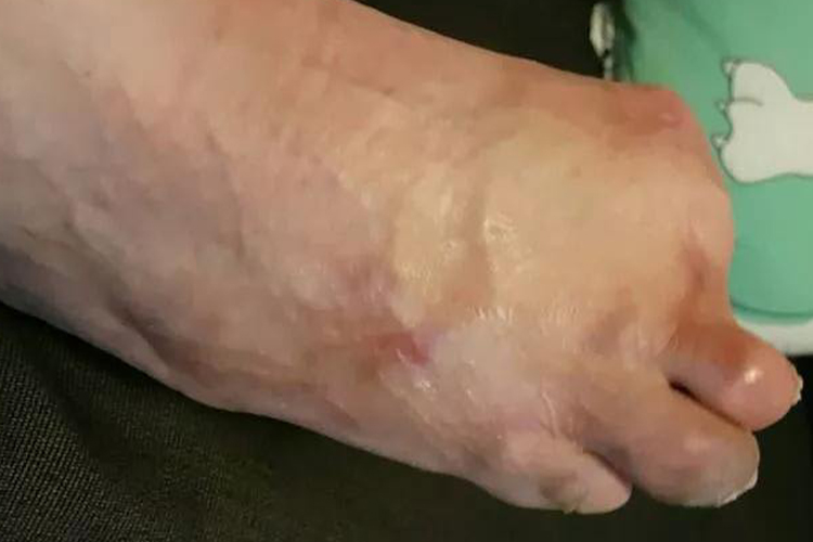 脚趾截肢术后图