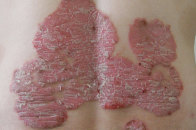 蛎壳状寻常型银屑病图