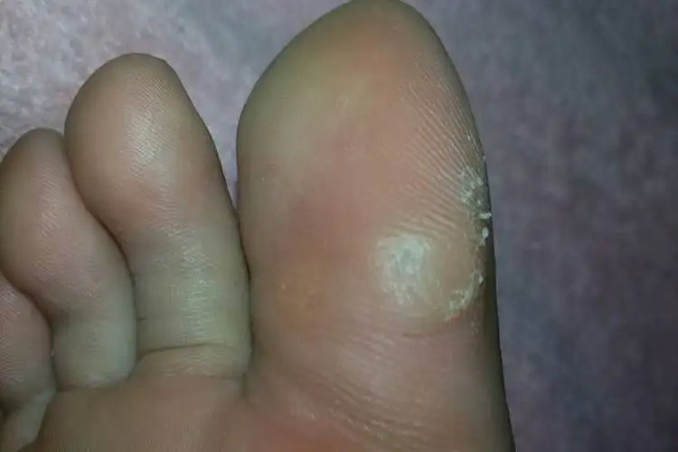 大脚趾旁边长胼胝图