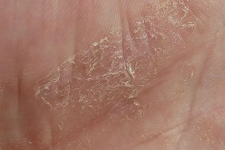 维生素A过多症手掌裂纹图