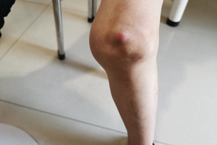 类风湿关节炎膝盖肿图 类风湿关节炎膝盖肿图