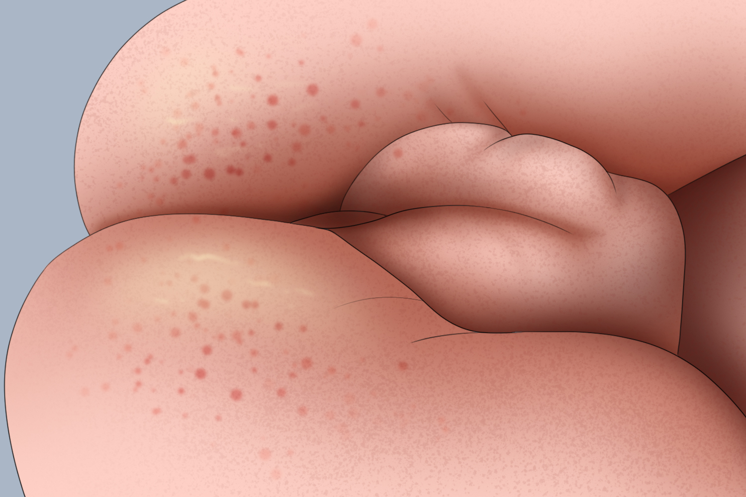 新生儿尿布湿疹图 新生儿尿布湿疹图