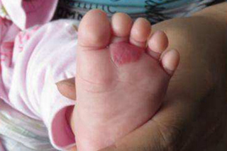 婴儿血管瘤脚底红斑图