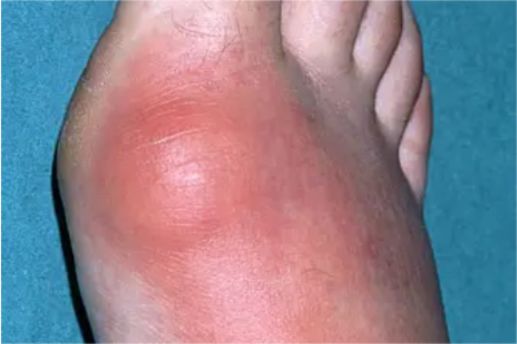 脚趾骨膜炎红肿图