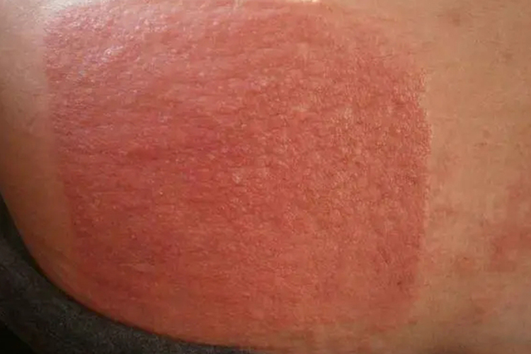 腹部接触性皮炎图