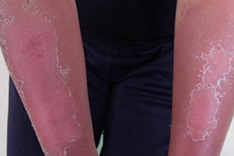 日晒伤胳膊发红且掉皮图 日晒伤胳膊发红且掉皮图