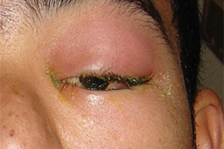 慢性泪腺炎左眼红肿图 慢性泪腺炎左眼红肿图