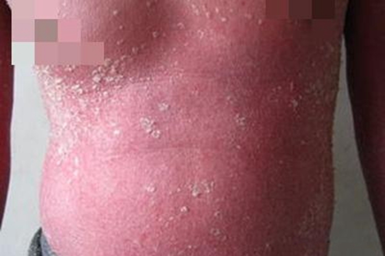 红皮病型银屑病腹部脱屑图 红皮病型银屑病腹部脱屑图