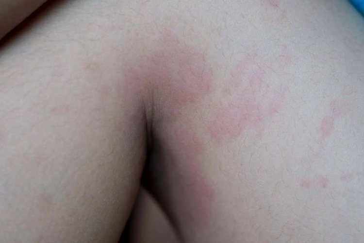 药物性荨麻疹图