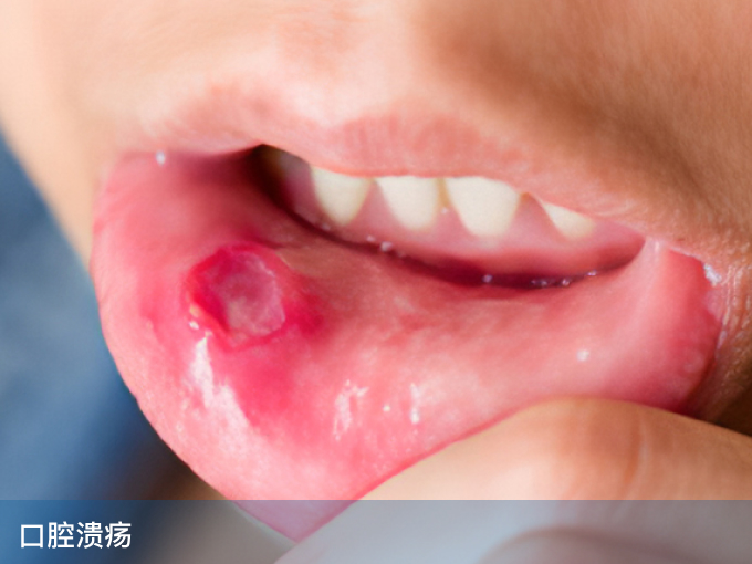 口腔溃疡