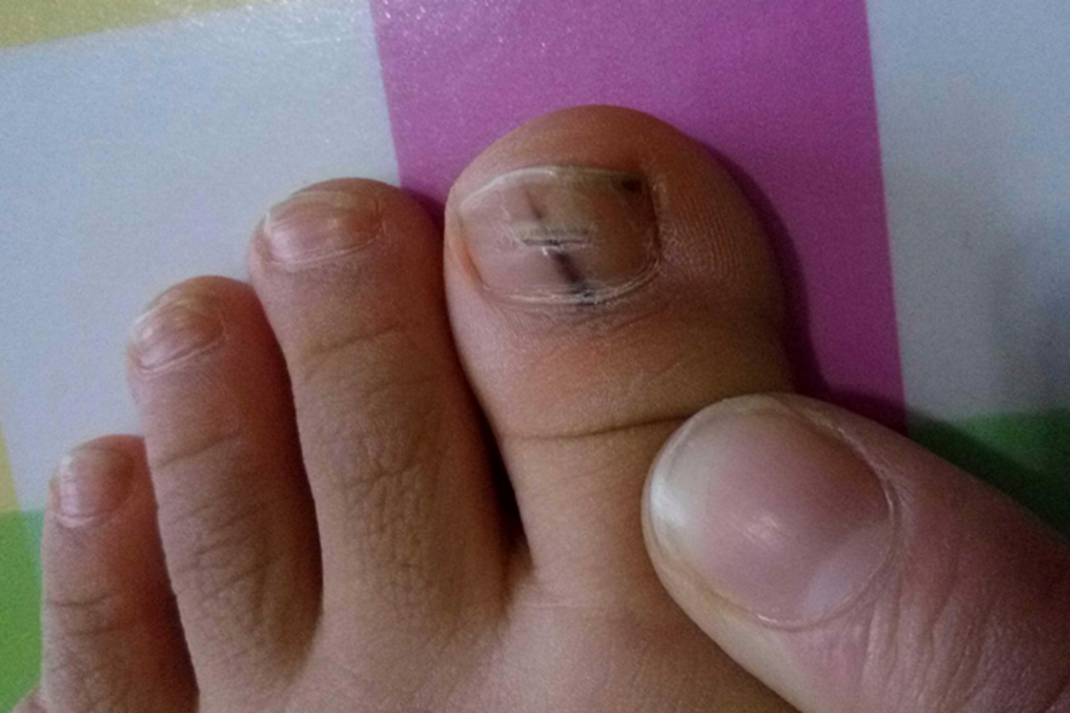 甲母质黑素细胞痣局部指甲图