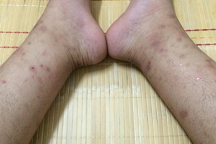 虫咬皮炎小腿斑图 虫咬皮炎小腿斑图