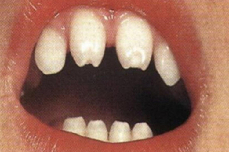 先天性梅毒牙缺损图 先天性梅毒牙缺损图