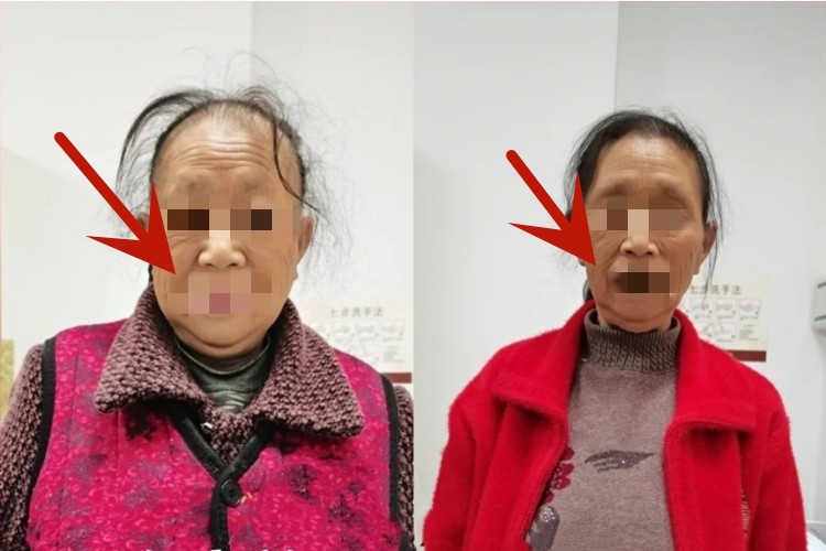 甲状腺功能减退症面色好转图