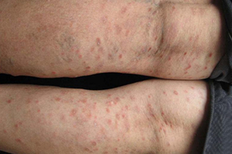 急性痘疮样苔藓样糠疹丘疹图