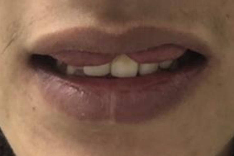 上唇部双层嘴唇图