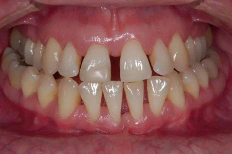 牙齿扇形移位图