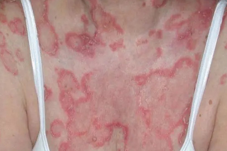 亚急性皮肤型红斑狼疮图 亚急性皮肤型红斑狼疮图