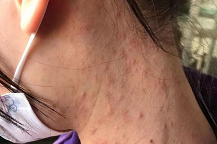 过敏性皮炎颈部侧边长皮疹图