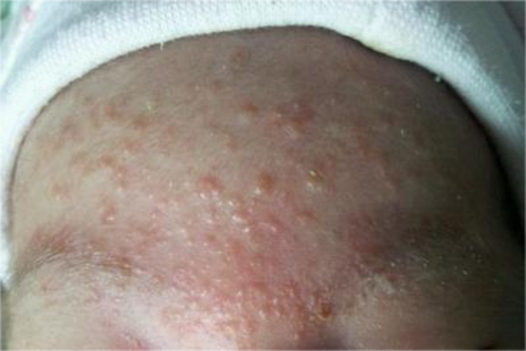 额头单纯疱疹症状图 额头单纯疱疹症状图