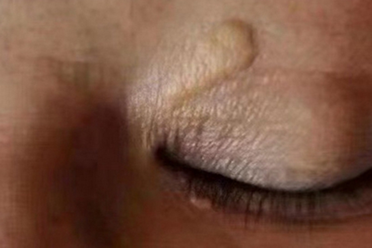 睑黄瘤睑边缘有小黄疙瘩图 睑黄瘤睑边缘有小黄疙瘩图