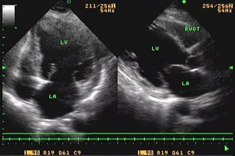 扩张型心肌病超声图 扩张型心肌病超声图
