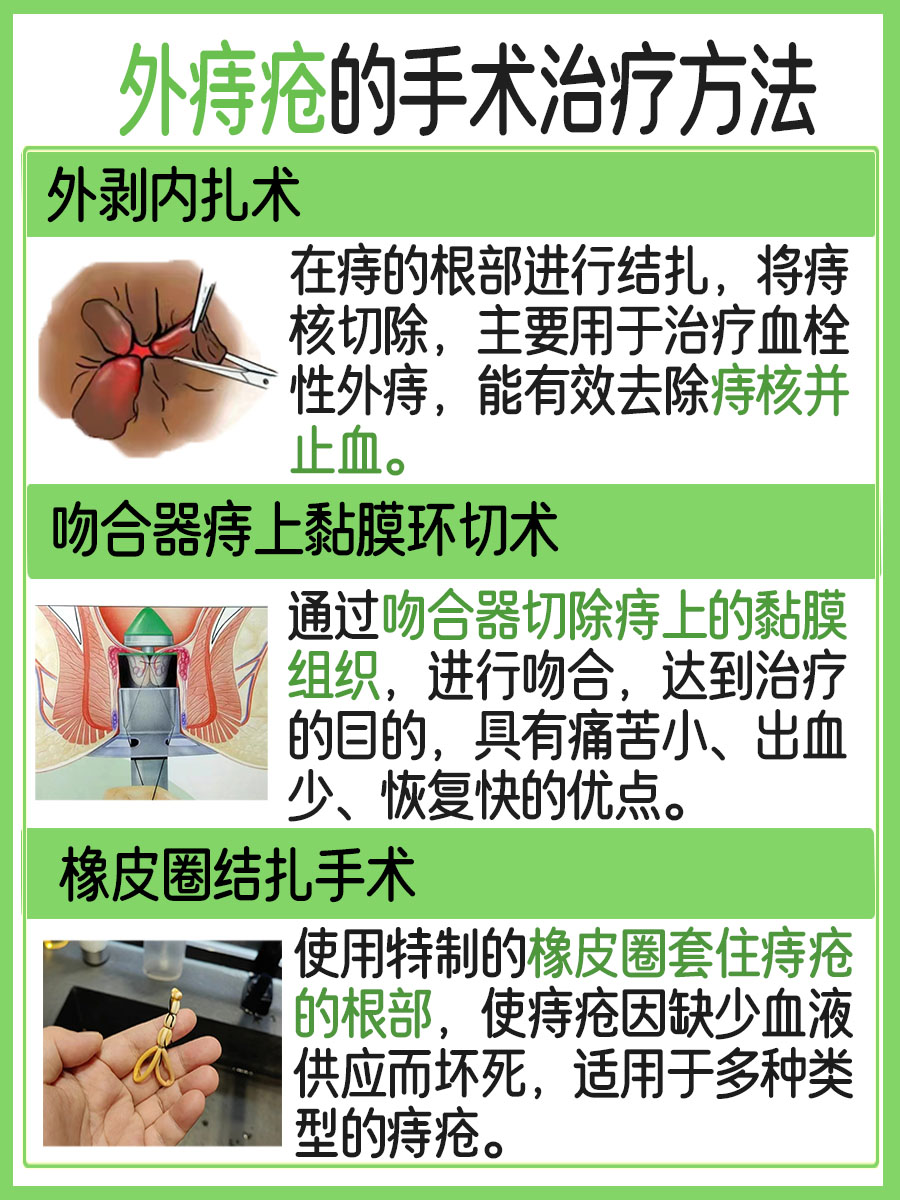 外痔疮用什么药 ，医生解答！