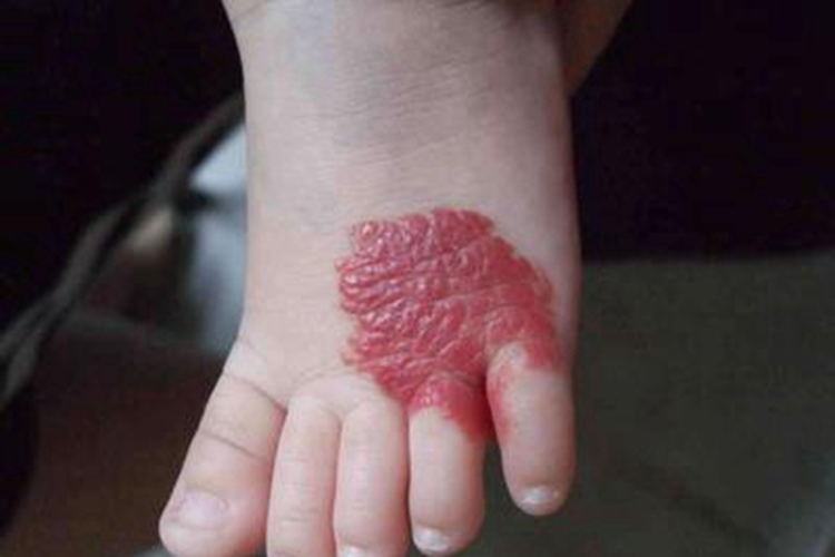 蔓状血管瘤脚背症状图 蔓状血管瘤脚背症状图