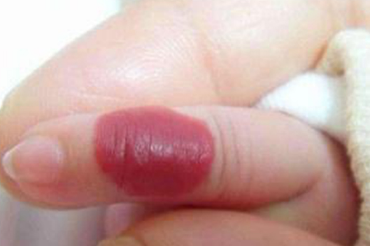 毛细血管瘤红斑图 毛细血管瘤红斑图