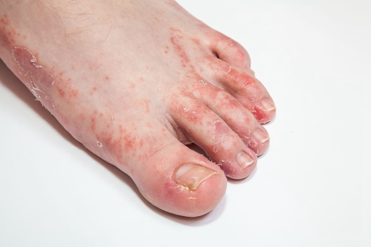 水疱型足癣脚趾红色疹子图