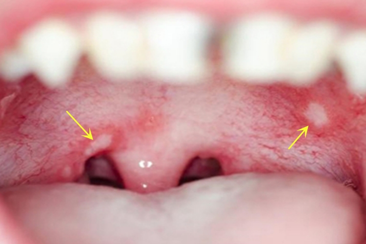 口腔溃疡上腭有溃疡图