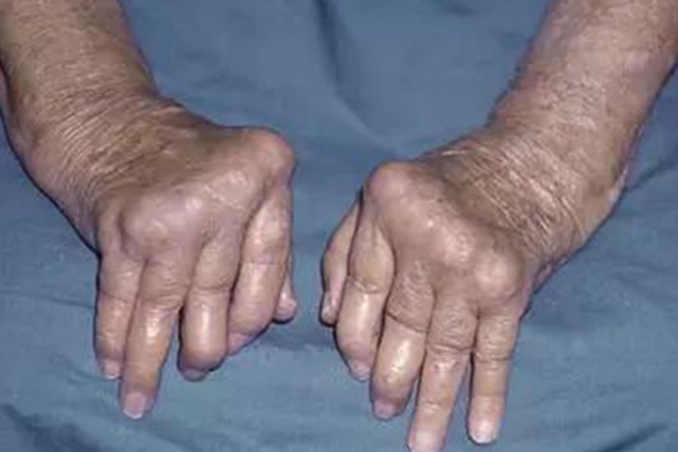 痛风手指有很多包块图 痛风手指有很多包块图