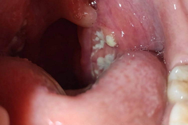 化脓性扁桃体炎扁桃体化脓图 化脓性扁桃体炎扁桃体化脓图