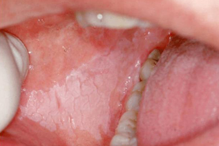 斑块状的口腔黏膜白斑图