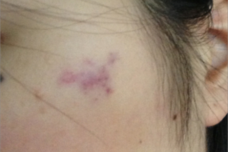 挫伤脸上紫了一小块图