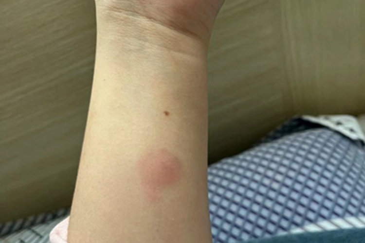 过敏性皮炎胳膊硬币样红斑图