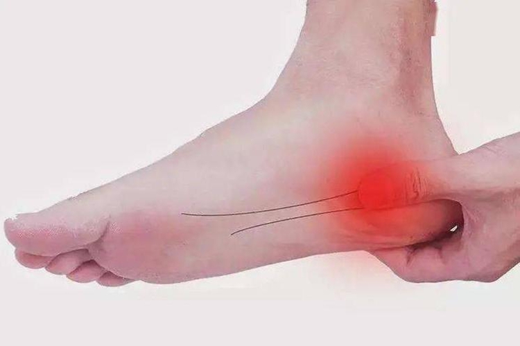 足底筋膜炎疼痛部位图