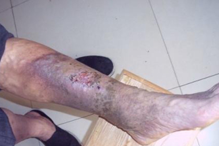 下肢深静脉血栓形成小腿发绀图