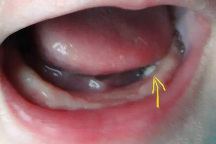 正常婴儿牙龈并有乳牙冒白尖图