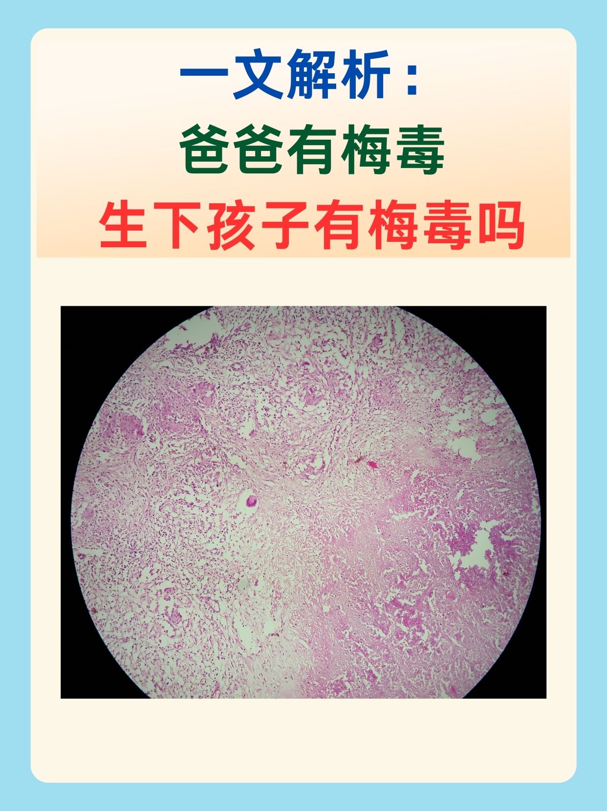 一文解析：爸爸有梅毒生下孩子有梅毒吗