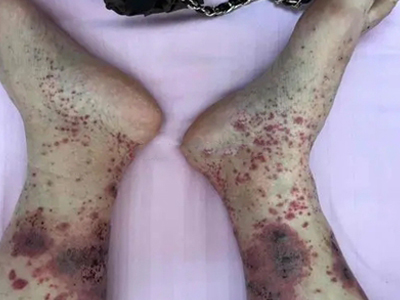 皮肤白血病小腿长紫色的斑图.jpg
