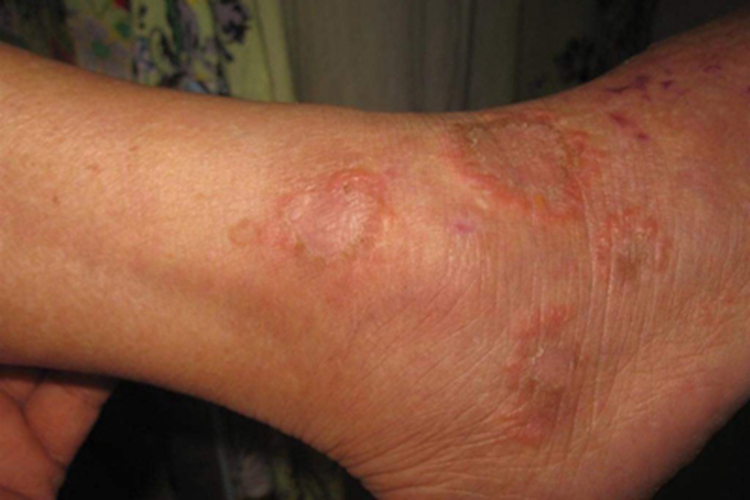 局限型环状肉芽肿症状图 局限型环状肉芽肿症状图