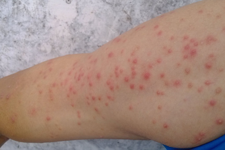 湿疹手臂接触性皮炎图急性发病,可突然出现皮肤瘙痒,搔抓后出现红斑