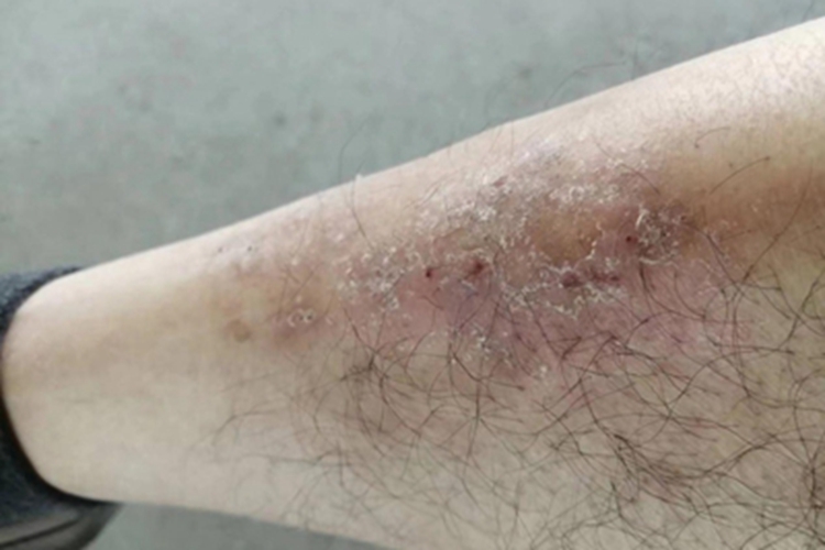 结痂性疥疮小腿脱屑图