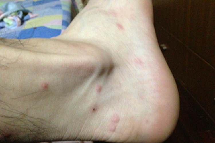 尾蚴性皮炎脚踝症状图 尾蚴性皮炎脚踝症状图