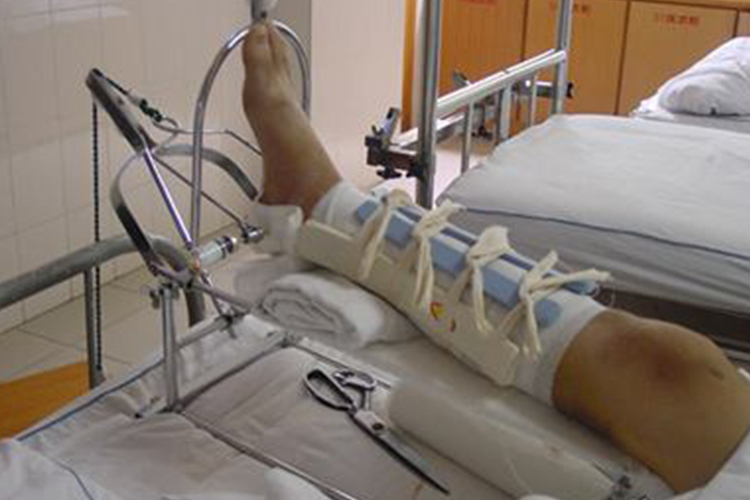 小腿骨折正确睡姿图