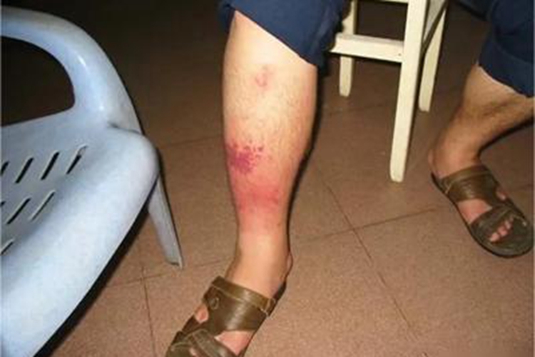 丹毒样型癣菌疹症状图