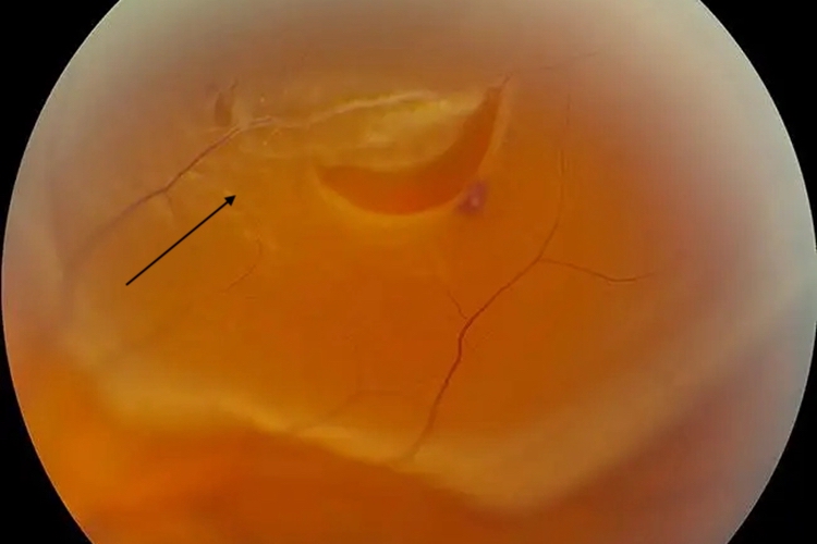 孔源性视网膜脱离图