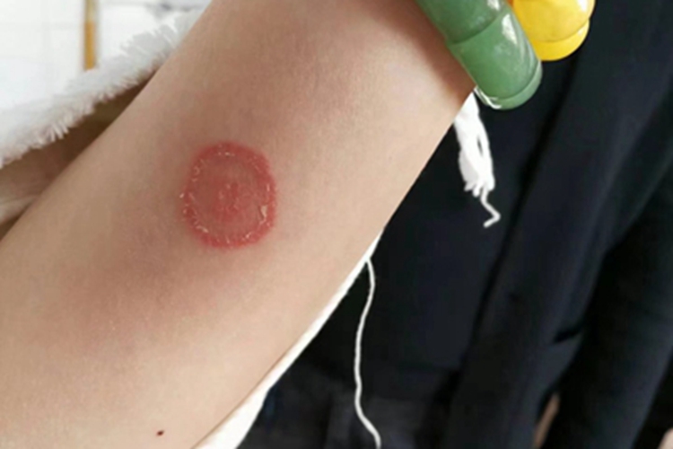 体癣胳膊上出现环形红斑图