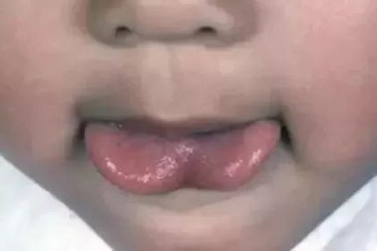 宝宝舌头轻微w型图